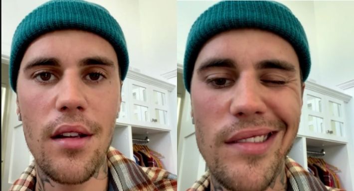 صدمة عالمية – جاستن بيبر يصاب بالشلل في وجه