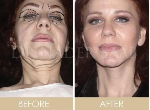 ميادة الحناوي عملت عملية تجميل ومش هتعرفها دلوقتي – شاهد