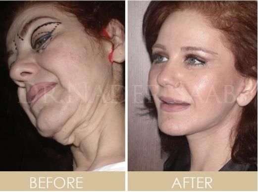 ميادة الحناوي عملت عملية تجميل ومش هتعرفها دلوقتي – شاهد