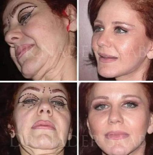 بالصور – ” ميادة الحناوي ” قبل وبعد عملية التجميل