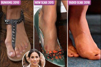 شاهد .. أصابع قدميّ ميغان ماركل حديث الصحف بعدما خضعت لـ عملية بهدف تجميلها -بالصور