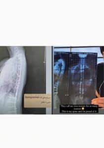 زينة مكي تعتذر لجمهورها بسبب صور عمودها الفقري.. التفاصيل الكاملة