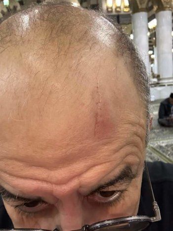 شاهد .. إصابة ممثل مصري في رأسه خلال تواجده بالمسجد النبوي.. هذا ما حصل