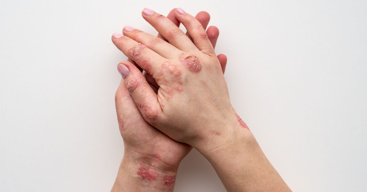 عاجل من الصحة بشأن ظهور سلالات جديدة من الدرن في مصر