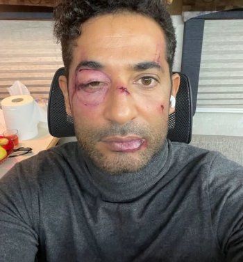 شاهد .. عمرو سعد يثير قلق متابعيه بصورة صادم.. هل تعرض للضرب؟