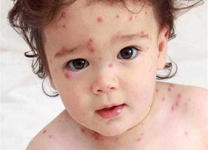 أخبار مصر | هل تؤجل الامتحانات بسبب مرض الجدري المائي؟.. التعليم تحسم الجدل