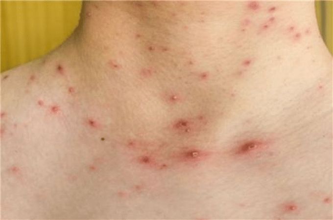 أخبار مصر | هل تؤجل الامتحانات بسبب مرض الجدري المائي؟.. التعليم تحسم الجدل