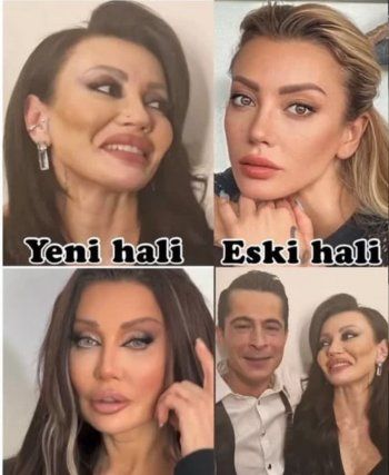 شاهد .. ممثلة تشوّه وجهها بسبب عمليات التجميل..تغيير جذري وسيء-بالصورة