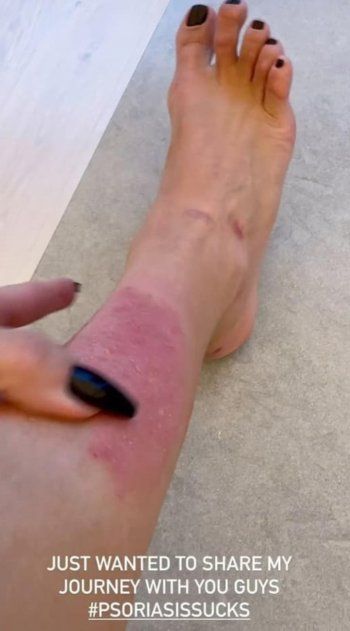 شاهد .. بالصورة- تفاقم معاناة كيم كارداشيان مع هذا المرض