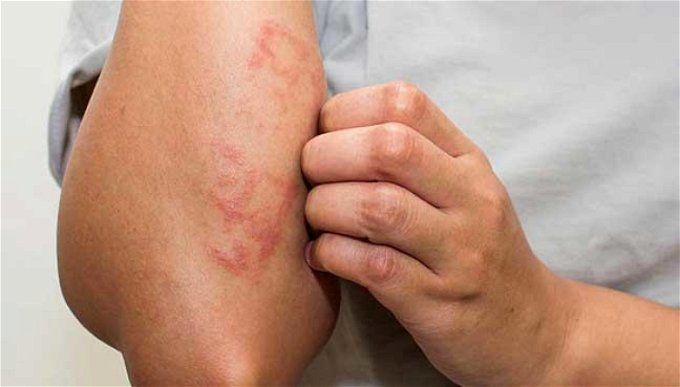 أخبار مصر | 9 أطعمة ممنوعة لمرضي الحساسية .. تعرف عليها وابتعد عنها فوراً