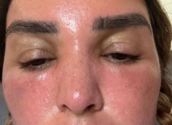 ضربة شمس تغير ملامح فنانة مصرية بشكل كامل