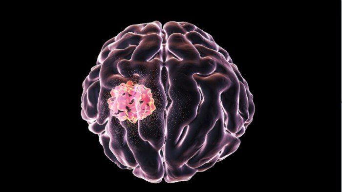 بشرى سارة.. عقار شائع لضغط الدم يبشر بعلاج ورم دماغي نادر