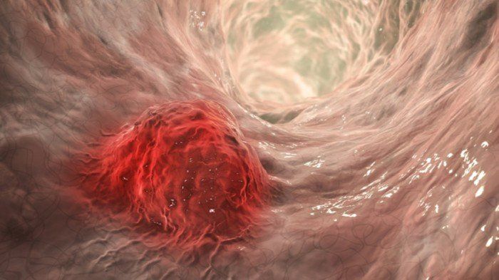 دراسة حديثة: الجسيمات البلاستيكية الدقيقة قد تكون سببًا للسرطانات غير المبررة