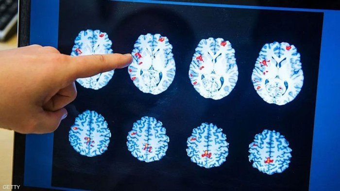 دراسة جديدة: استنشاق غاز الزينون قد يحمي أدمغة مرضى الزهايمر