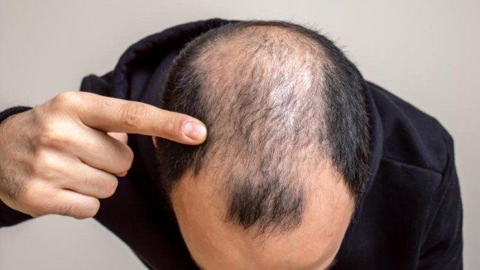 علماء يكتشفون "مفتاح سري" قد يكون الحل لتساقط الشعر