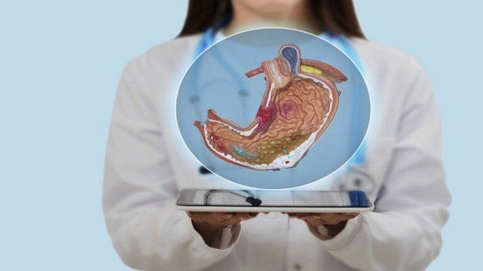 اكتشاف طبي مهم.. "فيتامين B5" قد يكون مفتاحاً لعلاج قرحة المعدة