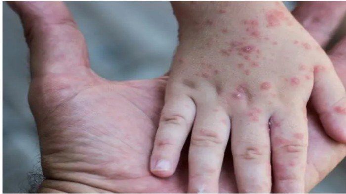 وسط قلق عالمي.. بريطانيا تسجل ثالث إصابة بجدري القردة في أقل من أسبوعين