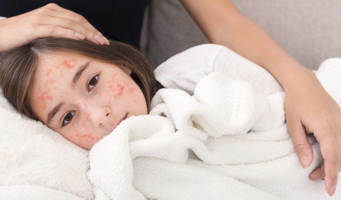 معظمهم من الأطفال والمراهقين.. ارتفاع عدد المصابين بـ«الحصبة» في تكساس لـ48 حالة.. ماذا يحدث؟