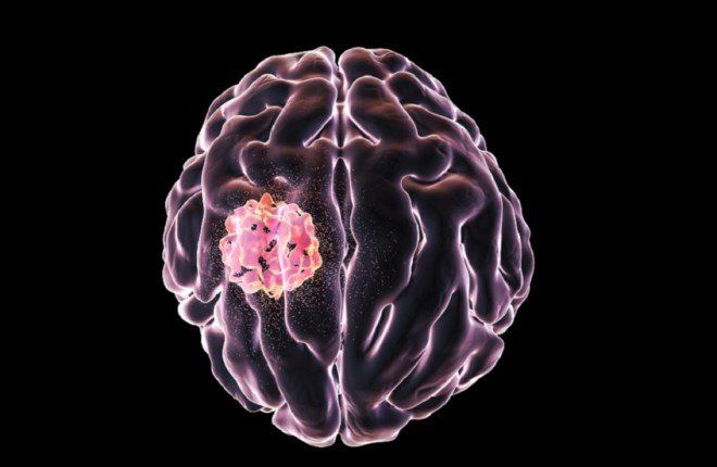 أطباء يحذرون من إمكانية تحول البقع الجلدية إلى ورم في الدماغ