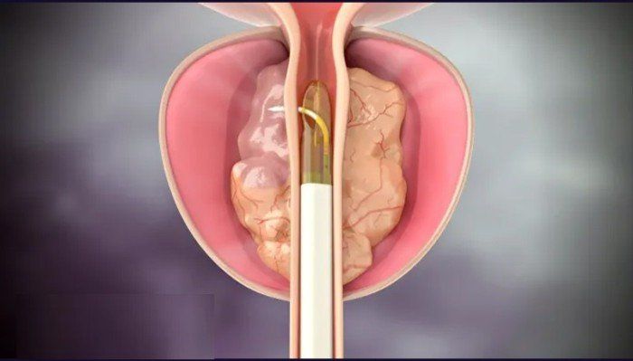 باحثون أمريكيون يطورون علاجا مبتكرا لسرطان البروستاتا دون جراحة