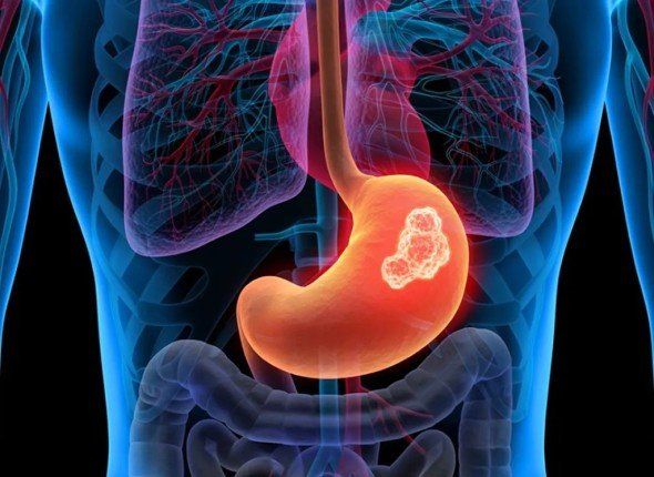 دراسة حديثة: الإفراط في تناول الملح يزيد خطر الإصابة بسرطان المعدة