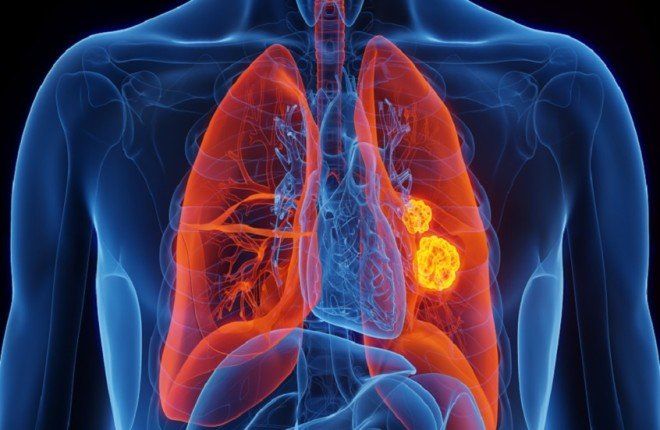 دراسة حديثة تكشف دور التغذية في سرطان الرئة.. "الغليكوجين.. وقود الأورام الخفي"