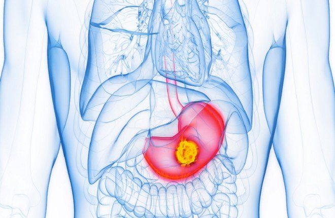دراسة جديدة تكشف عن مراحل مبكرة وسبب محتمل جديد لسرطان المعدة