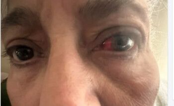 شاهد .. والدة منة فضالي تتعرض لإصابة في عينها وهذا ما حصل!