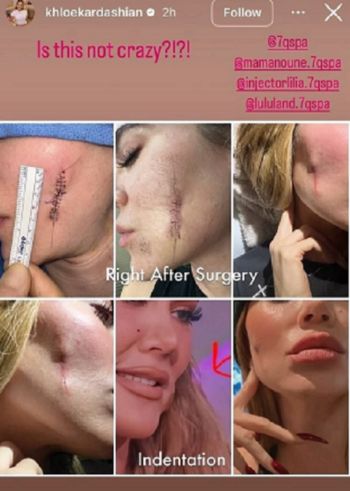 شاهد .. كلوي كارداشيان تُظهر آثار المعركة مع السرطان .. صور جريئة تظهر للمرة الأولى