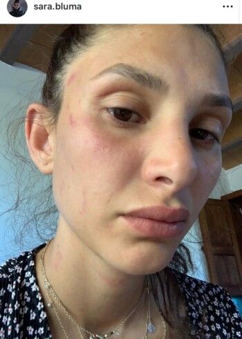 شاهد .. آثار الضرب على وجهها.. حبيبة جان يامان الجزائرية تكسر صمتها وتتحدث عن معاناتها