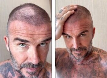 شاهد .. "بقعة الصلع" مفاجئة في رأس ديفيد بيكهام