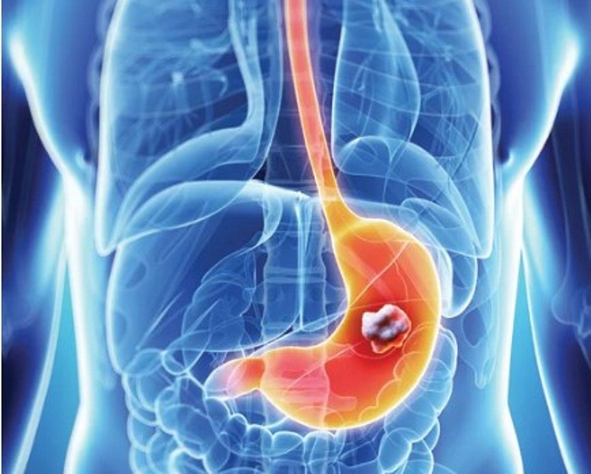 اتفرج – استشاري: 4 نصائح طبية للوقاية من سرطان المعدة