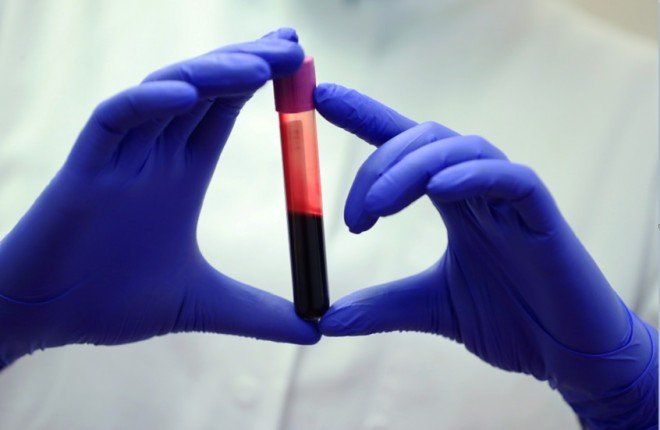 اختبار دم ثوري يشخّص متلازمة التعب المزمن بدقة تصل إلى 96%