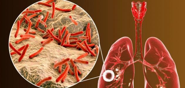 ابتكار طبي جديد لتشخيص مرض السل عبر هواء الزفير