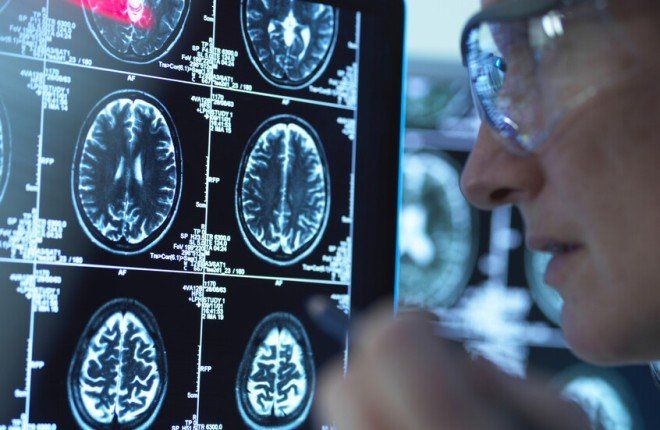 اكتشاف علمي يفتح آفاقاً جديدة لعلاج ألزهايمر باستخدام مادة طبيعية في الجسم