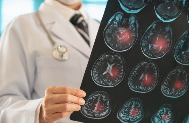 جهاز ثوري يعيد الكلام لمرضى السكتة الدماغية دون جراحة دماغية