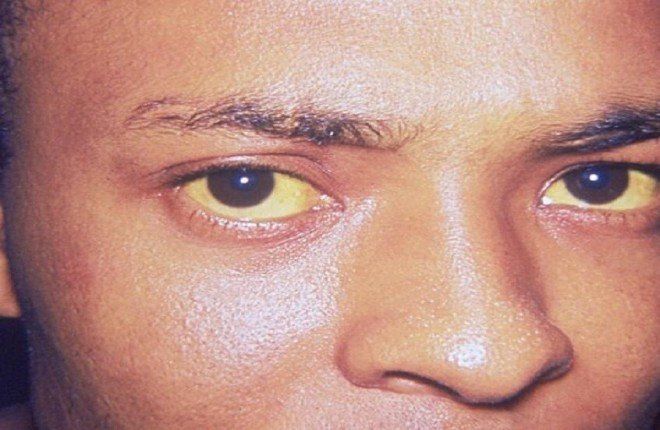 البشرة تكشف أمراض المرارة.. طبيبة تحذر من علامات لا يجب تجاهلها