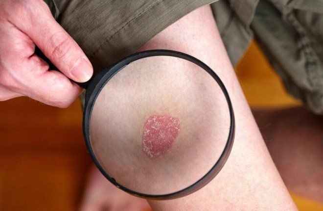 دراسة جديدة: النظام الغذائي النباتي قد يخفف أعراض الصدفية