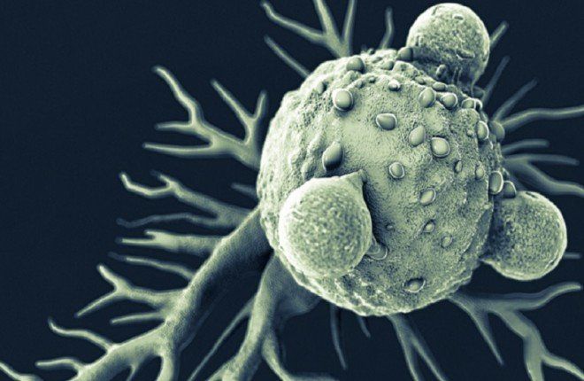 اكتشاف "إشارة إنذار مبكر" لسرطان البنكرياس قد يغير موازين التشخيص