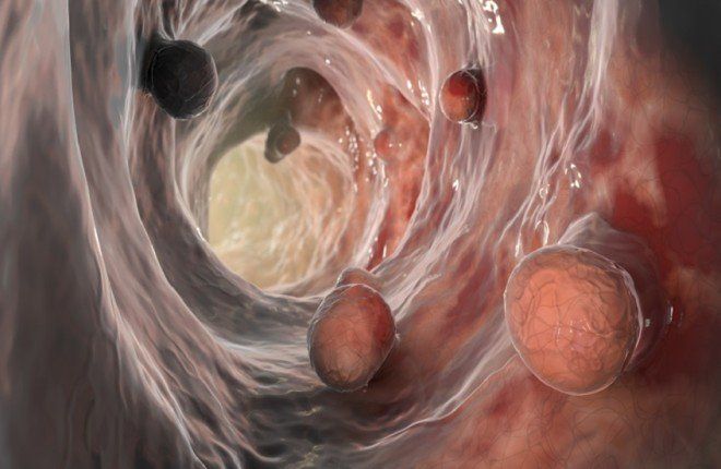 دراسة تربط بين المشروبات المحلاة بالسكر وزيادة خطر الإصابة بسرطان الأمعاء قبل سن الخمسين