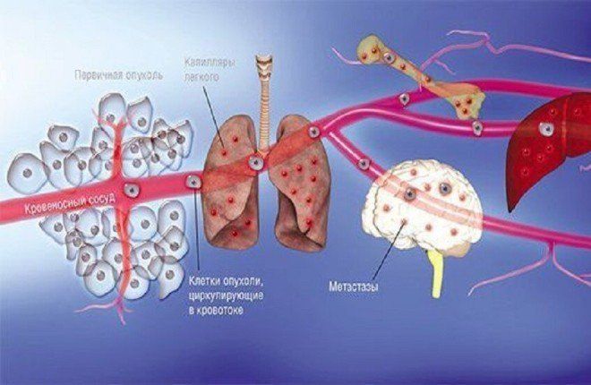 نموذج رياضي روسي جديد يتنبأ بانتشار الخلايا السرطانية