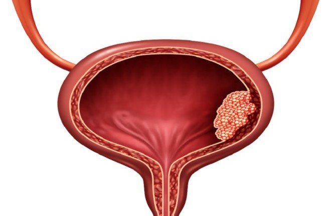 شركة روسية تبدأ الدراسات السريرية لعقار مبتكر لعلاج سرطان المثانة