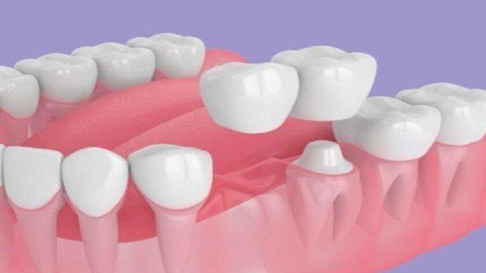 ابتكار روسي جديد قد يغني عن زراعة الأسنان ويخفض تكلفة العلاج للنصف