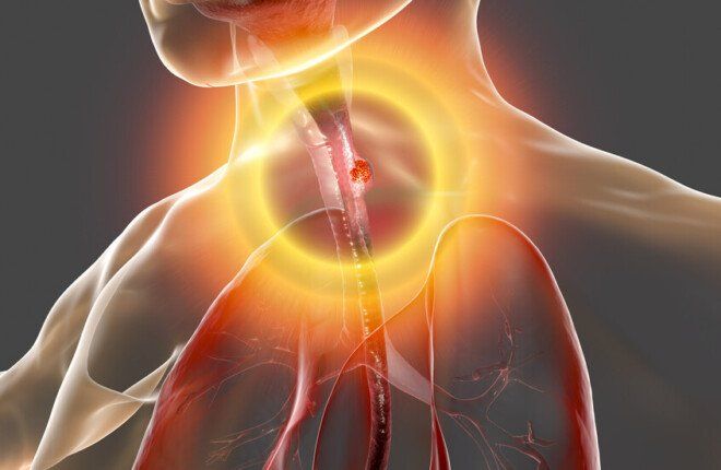 اكتشاف “علامة خفية” قد تغيّر تشخيص أخطر أنواع سرطان المريء