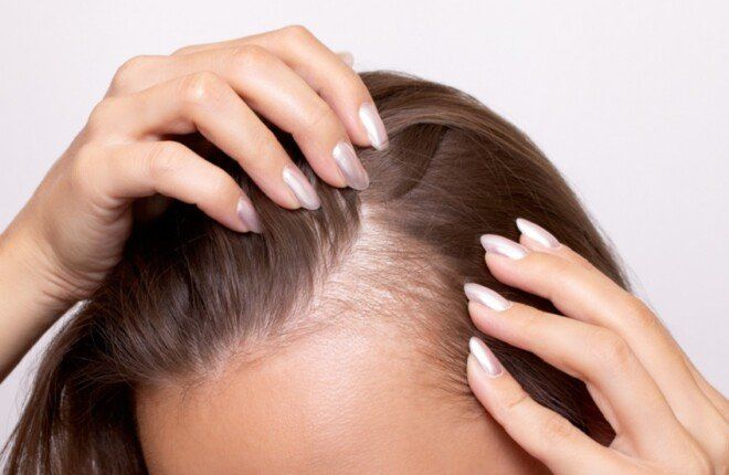 دواء فموي مبتكر يعزز نمو الشعر بنتائج واعدة خلال 6 أشهر