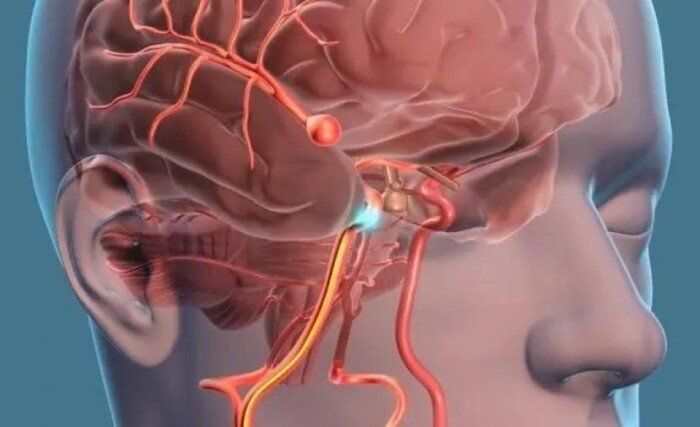 دراسة جديدة: السكتات الدماغية اللكونية مرتبطة بتوسع الأوعية الدقيقة وليس بترسبات الدهون