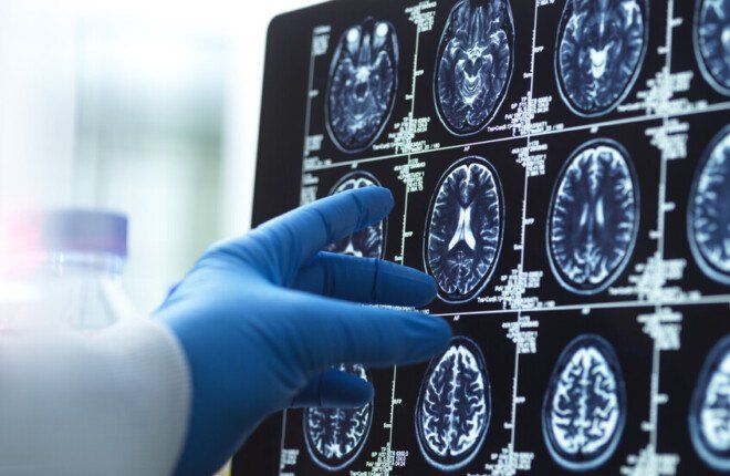 لعبة ذهنية بسيطة قد تقلل خطر الخرف بنسبة 25%
