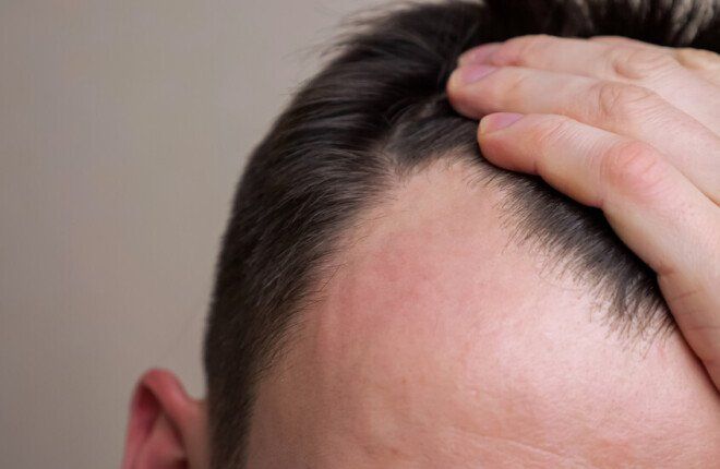 دراسة تحذر: أدوية إنقاص الوزن قد تزيد خطر تساقط الشعر لدى بعض الرجال