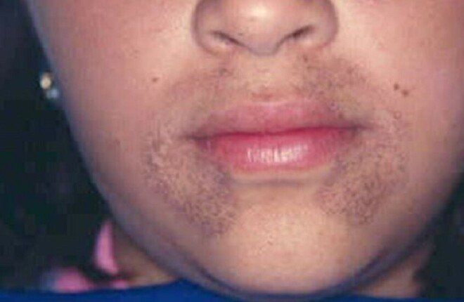 تغير لون البول إلى الأسود بعد تعرضه للهواء.. علامة على مرض وراثي نادر