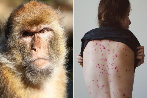 باكستان تعلن عن أول إصابة بفيروس جدري القردة في البلاد